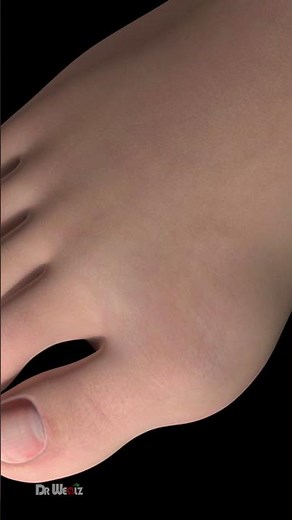 Why Do Some People Get Bunions? The Science Behind It