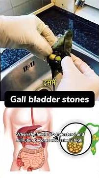 Gall bladder stone | Dr. SRK | energyclinic | #reels #physiotherapist #yoga #exercise