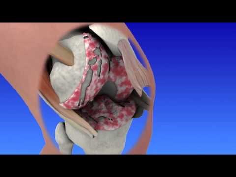 Total Knee Replacement