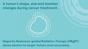 24 reactions | How does MRgRT with Elekta Unity work? During treatment, a tumor’s size, shape and location can change. MRgRT allows doctors to react to those changes and ensure the tumor is more accurately targeted. Find out more about how it works and other FAQs here  https://bit.ly/3Z5eUqd #cancertreatment #MRLinac #radiationtherapy | Elekta | Facebook
