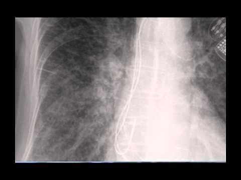 Chest x-ray -- Difference between Kerley B lines and blood vessels