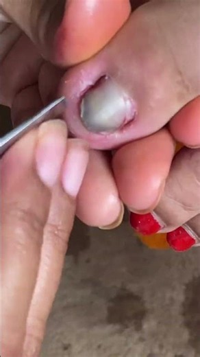 爪水虫 初期症状, 水虫 かゆくない #shorts #fungal #fungalinfectiontreatment