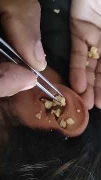 Insane Ear Wax Removal 😱 | You Won’t Believe This!