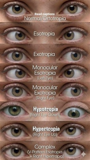 TYPES OF SQUNIT 👀👀#optometry #squint#opthalmology#youtubeshorts#viralvideo#viralshort#dailyshorts
