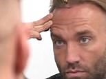Calum Best undergoes another transplant using hair from his BEARD