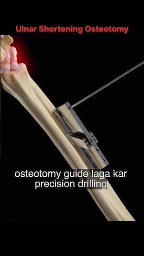 Ulnar Shortening Osteotomy. @I‪@IamMedicodp‬#orthopedics #anatomy #physiotherapist #orthoconcepts