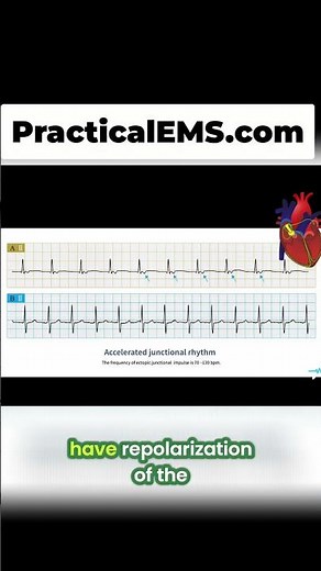 Junctional Rhythm: EKG Secrets Revealed! Learn This NOW! #shorts