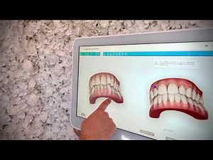 Invisalign smile simulation using Itero digital scanner