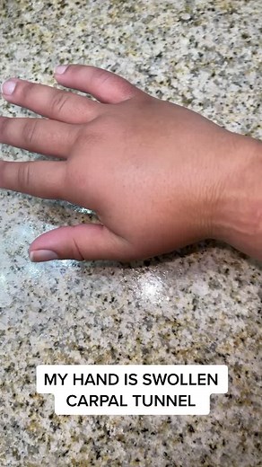 Understanding Swollen Hands and Carpal Tunnel Symptoms