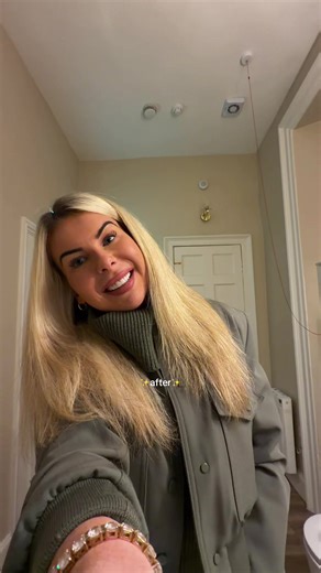 my smile transformation 🥺✨ #allsmiles #transformation #makeover #fyp
