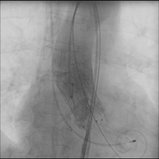 One of the most significant medical advances in cardiology in recent decades is the transcatheter aortic valve implantation (TAVI). In this long and demanding intervention the Ziehm Vision RFD Hybrid Edition Cardio is a reliable partner and supports surgeons with excellent image quality. | Ziehm Imaging