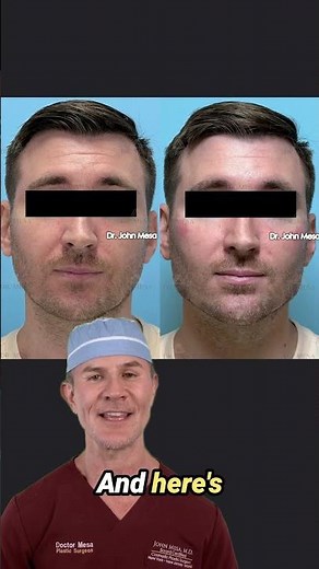 Facial Masculinization for a Stronger, More Defined Masculine Look #FillersForMen #beforeandafter