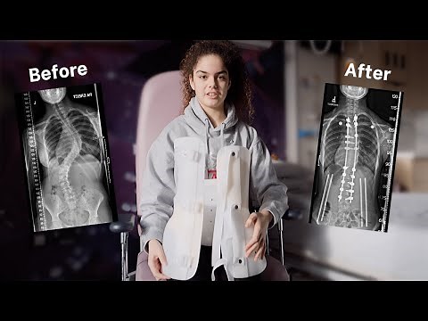 Scoliosis surgery using the Mazor X Stealth surgical robot: Emma's story
