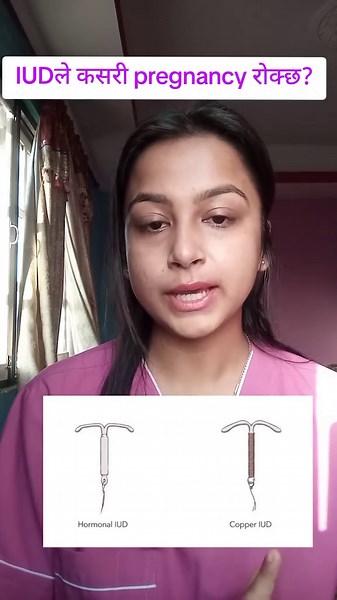 What is an IUD and how does it prevent pregnancy? An intrauterine device (IUD) is a small device placed inside the uterus by a trained healthcare provider. It is a long-term and highly effective birth control method. Some IUDs use copper to stop sperm from fertilizing the egg, while others release hormones to prevent pregnancy. In this video, we explain what an IUD is and how it works. . . . . . . . . . . #iud #pregnant #womenshealth #healthawareness #reproductivehealth