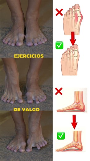 💥 Pies Fuertes contra el Valgus: Los Mejores Ejercicios para Alinear 📥 OBTÉN LA RUTINA #shorts