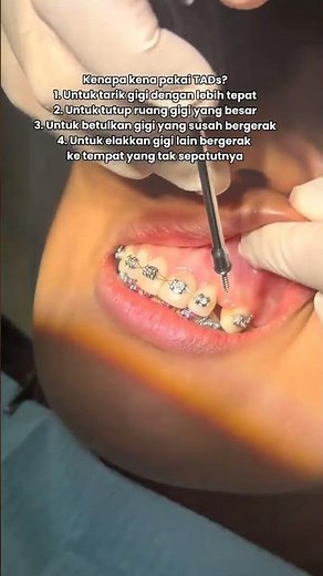 ✨ The best moment of treatment is achieving the final result! 😁🦷A beautiful smile after removing