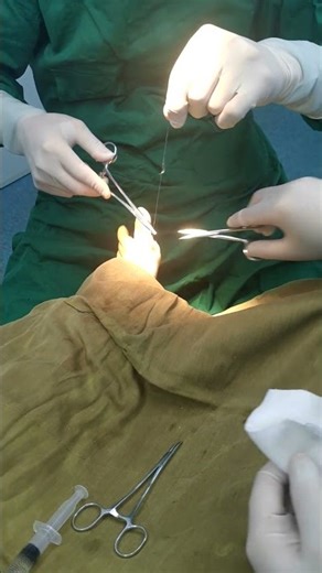 湖南长沙大脚骨手术矫正，拇趾外翻矫正，大脚骨手术 #hallux