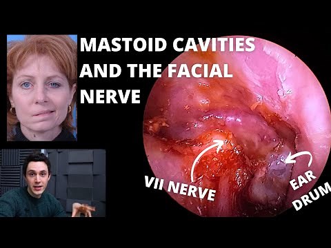 Mastoid Cavity Ear Surgery & The Facial Nerve Explained