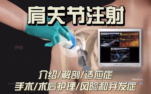 肩关节注射介绍/解剖/适应症/手术/术后护理/风险和并发症丨Intra-Articular Shoulder Injections