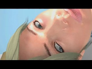 【眩晕】Epley 手法治疗BPPV眩晕【后半规管】--旋转眼震