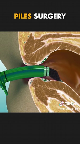 Rubber Band Surgery For Piles: Quick, Effective Treatment