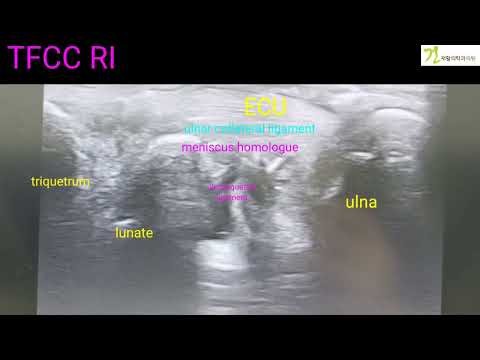 화룡점정 4-8 TFCC Regenerative solution injection