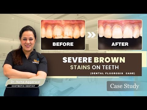Brown Teeth Stains Gone | Dr. Neha Aggarwal
