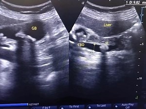 comparison between normal and pathological findings of the common bile duct (CBD)—particularly relevant for sonologists, radiologists, and clinicians using ultrasound or other imaging modalities. ✅ Normal Common Bile Duct Anatomy: The common bile duct is formed by the union of the common hepatic duct and cystic duct. It passes posterior to the duodenum and pancreatic head, draining into the ampulla of Vater in the second part of the duodenum. Normal Ultrasound Features: Diameter: ≤ 6 mm is consi