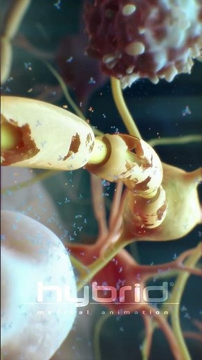 Multiple sclerosis (MS) animation | myelin sheath destruction | medical animation | MS animation