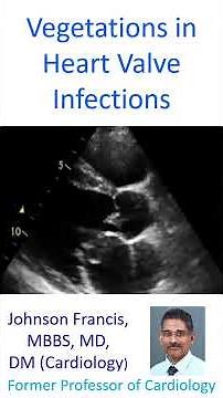 Vegetations in heart valve infections