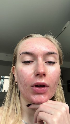 slathering aquaphor all over my face because my skin is raw and burnt from walking around yesterday! With sunscreen and a moisturizer!!! #acne #newyork #nyc #newyorkcity #nyccontentcreator #contentcreator #goals #nycinfluencer #accutane #insecurity #anxiety #columbia #columbiastudent #columbiauniversity #motivation #wellness #skincare #relatable #skincaretips #accutanejourney #accutanediary #selflove #confidence #bodypositivity #dry #grwm #dryskin