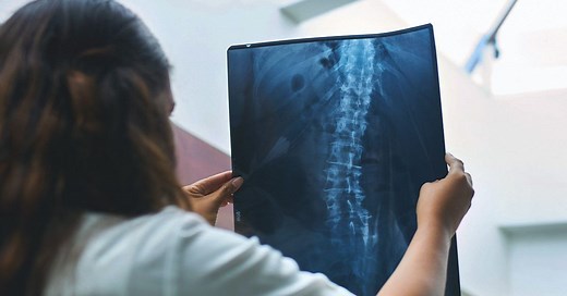 Everything You Need to Know About Scoliosis