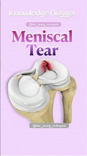 Meniscal Tear Types in 30 Seconds 🦵 | Bucket Handle, Radial, Flap & More | Ortho Exam Rapid Review