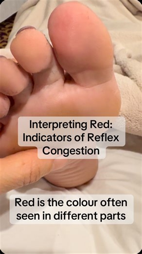 33 reactions | Interpreting Red: Indicators of Reflex Congestion -Red is the colour often seen in different parts of the feet often indicating the area corresponding to the reflex is under pressure. As therapists, careful observation of reflex colour provides valuable information, guiding our approach to the treatment and supporting the healing process. #Reflexology #FootTherapy #HealingHands #TherapistInsights #BodyWellness | Irish School of Reflexology & Wellness | Facebook