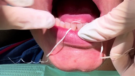 Effective Flossing Techniques for Lingual Retainers