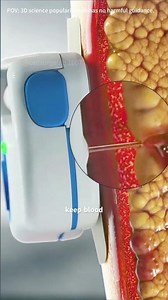 Insulin Pump Working Medical Animation 3D#insulin #insulinpump #space #automobile