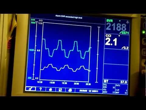 Edwards Vigilance II Patient Cardiac Monitor: Data Setup and Demo Mode (Vitalsguy.com)