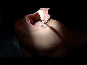 Access Edge® Kaolin Clay Retraction Paste