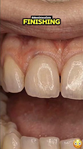 Mancha escura na superfície dos dente, sério? Pode ser cárie. Hora de ir ao dentista, sua saúde pede