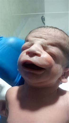 #Micrognathia #NewbornCare #NICUNurse #InitialAssessment #RBSMonitoring #NeonatalCare #nicucare