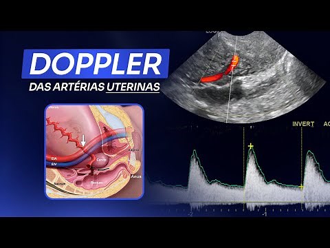Doppler das Artérias Uterinas | Ultrassom obstétrico