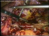 Perforated Peptic Ulcer - Laparoscopic Treatment • Video • MEDtube.net