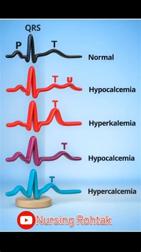 ECG graph 📈#ecg #ecgtest #cardio #ytshorts#youtubeshorts #nursing #viral#cardiology #disease#anatomy
