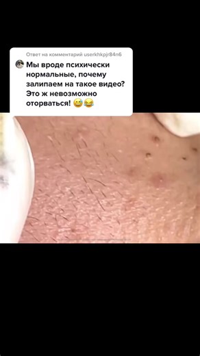 Ответ пользователю @userkhkpjr84n6 #acnetreatment #pimplepopping #чёрныеточки #прыщи #blackheads #давитьпрыщи #acne #disgustingsatisfaction