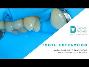 Tooth extraction with immediate placement of a temporary bridge. 🦷
