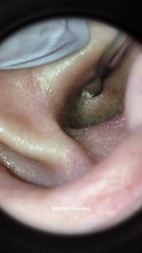 Ear blackheads 😳 #blackheads #supersatisfying #extractionsatisfaciton #pimplepop