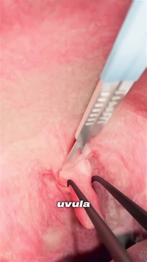 What happens if the uvula is cut? #medicine #biology #science