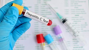 Hepatitis C symptoms: What is the treatment?