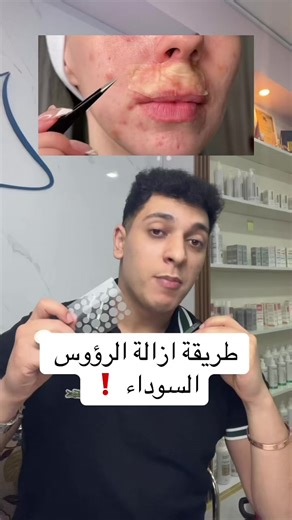 طريقة فعالة لإزالة الرؤوس السوداء بالقرفة والعسل