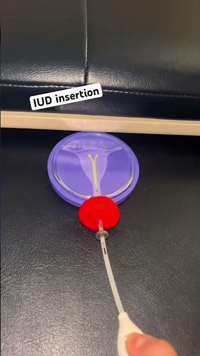 What really happens during an IUD insertion? Here’s a quick visual explanation. 👩‍⚕️✨